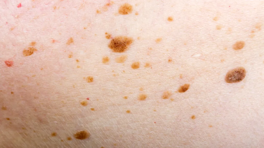 Diagnosis of Seborrheic Keratosis