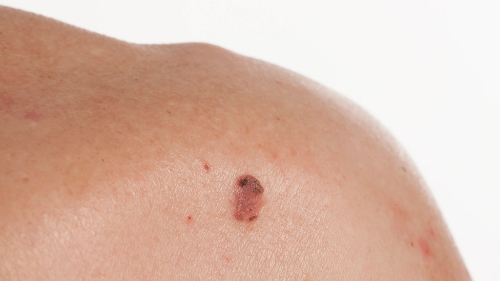 Lichenoid Keratosis