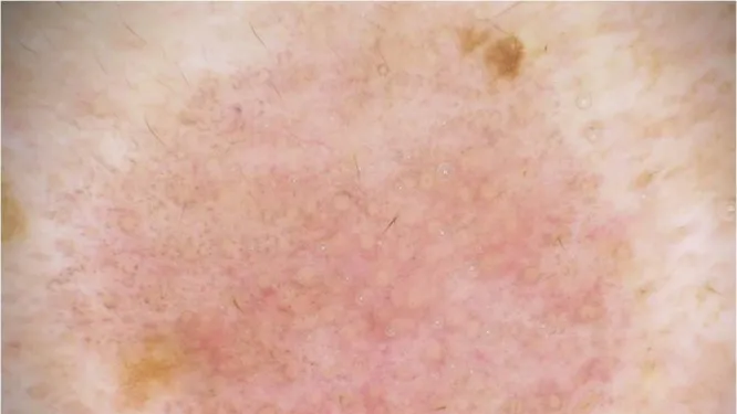 Dermoscopic Features of Lichenoid Keratosis