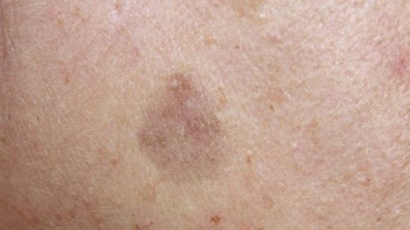 Lichenoid Keratosis