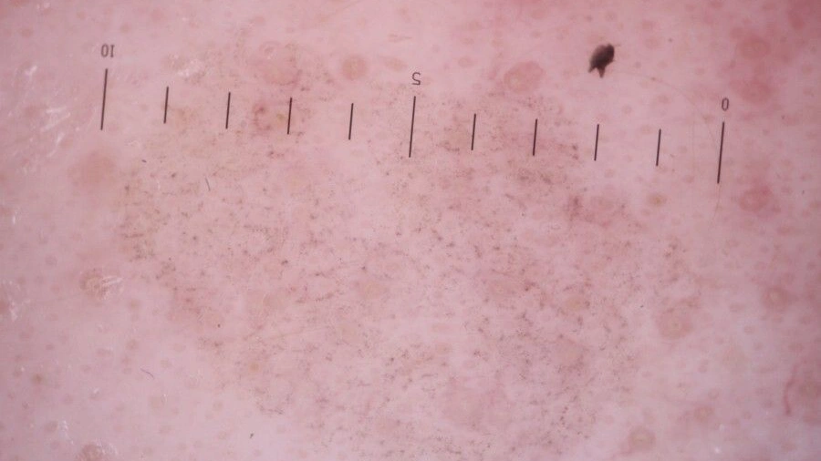 Dermoscopic Image
