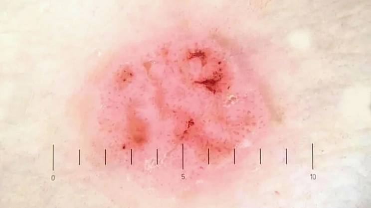 Dermoscopy of Bowen Disease