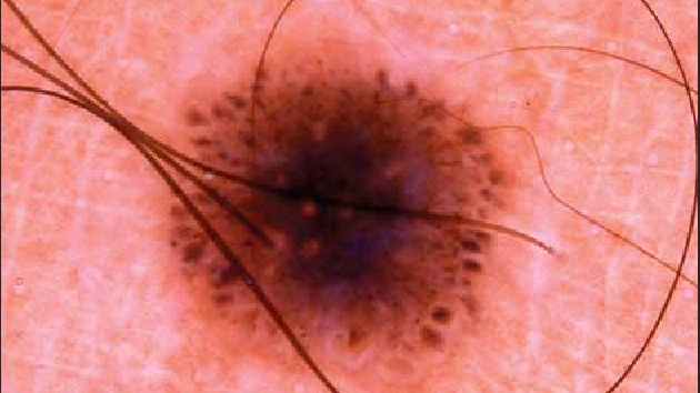 Dermoscopy of Spitz Nevus