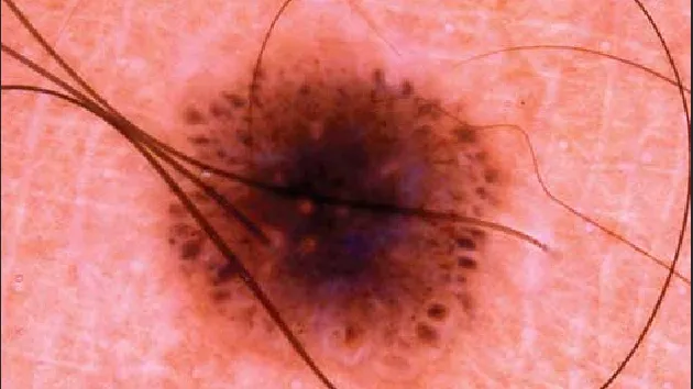 Dermoscopy of Spitz Nevus