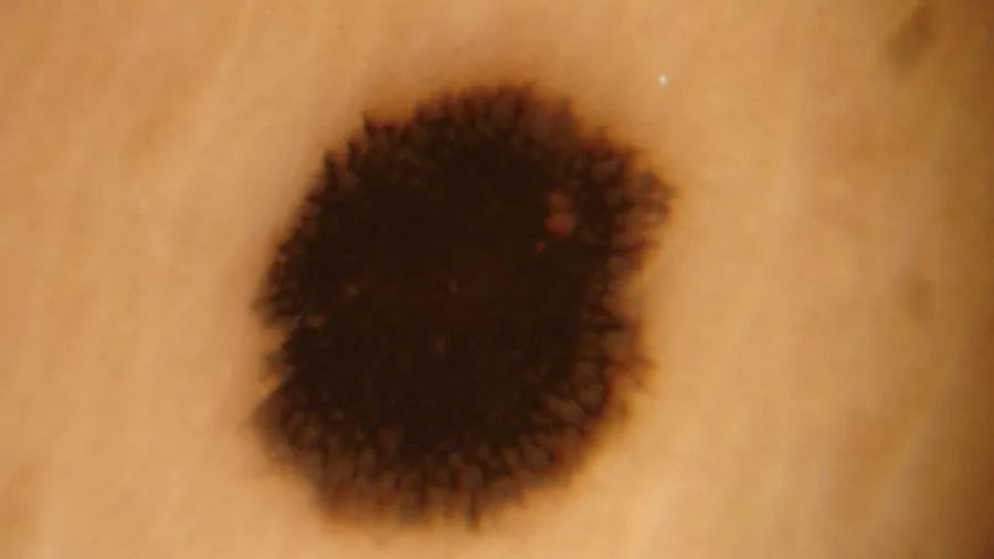 Dermoscopic Features of Spitz's Nevus