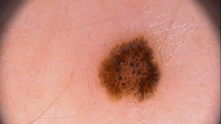 Spitz Nevus