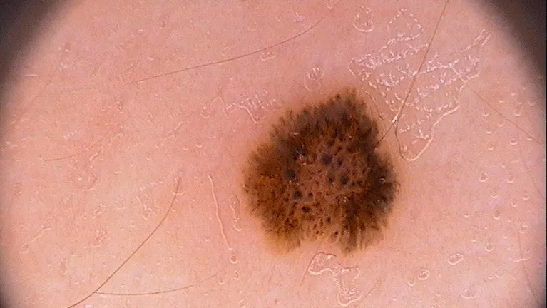 Spitz Nevus