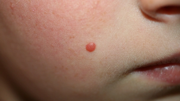Spitz Nevus Clinical Image