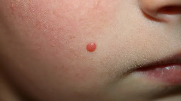 Spitz Nevus Clinical Image