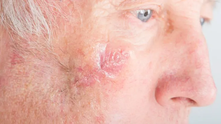 Squamous Cell Carcinoma