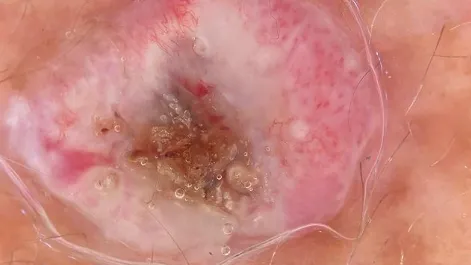 Dermoscopy of Squamous Cell Carcinoma