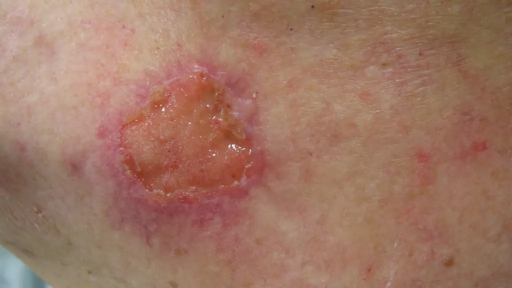 Squamous Cell Carcinoma of the Skin