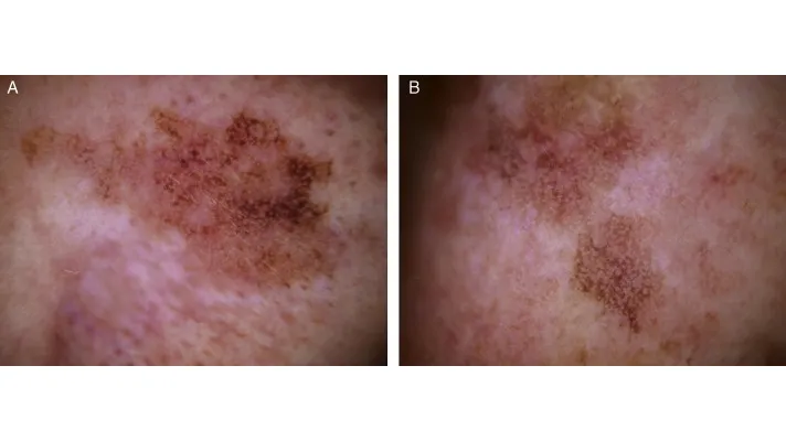 Pigmented Actinic Keratosis