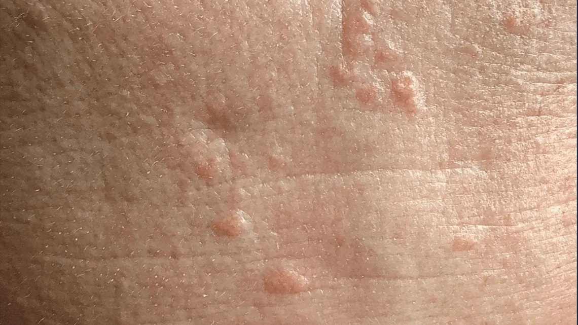 Sebaceous Hyperplasia