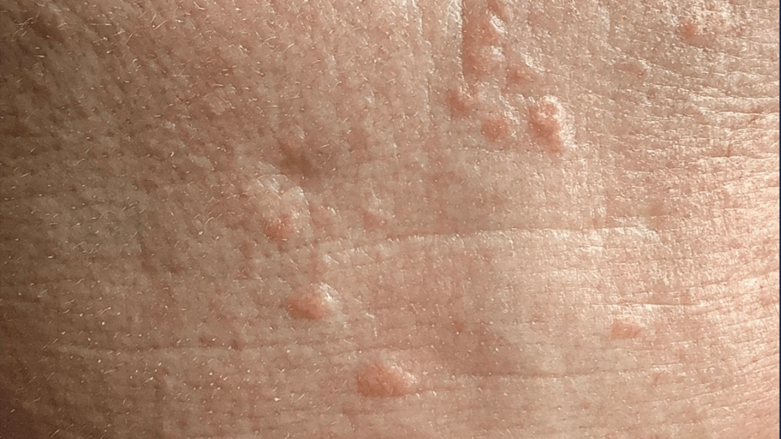 Sebaceous Hyperplasia