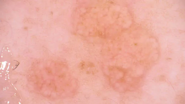 Dermoscopy of Sebaceous Hyperplasia