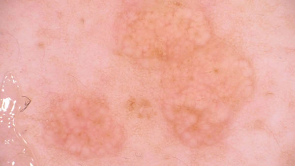 Dermoscopy of Sebaceous Hyperplasia