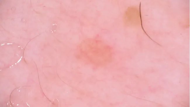 Sebaceous Hyperplasia Dermoscopy