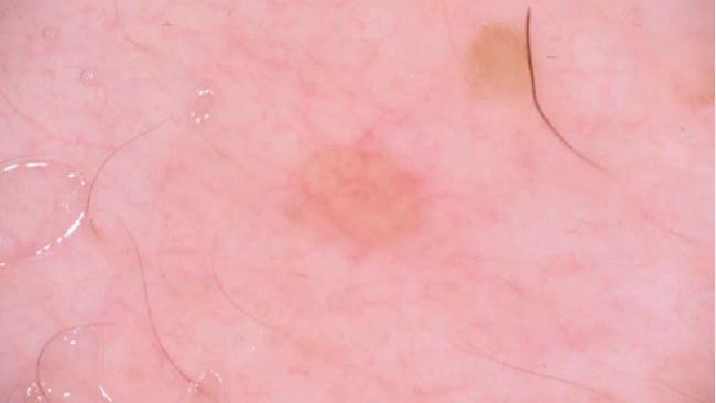 Sebaceous Hyperplasia Dermoscopy