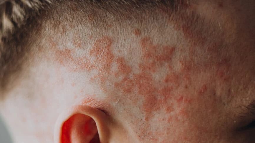 Scalp Psoriasis