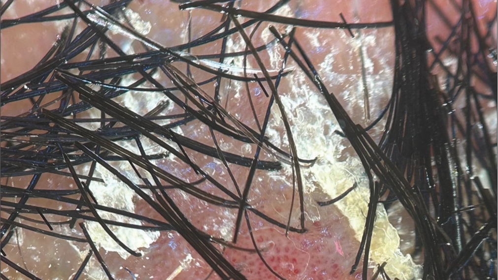 Dermoscopic of Scalp Psoriasis