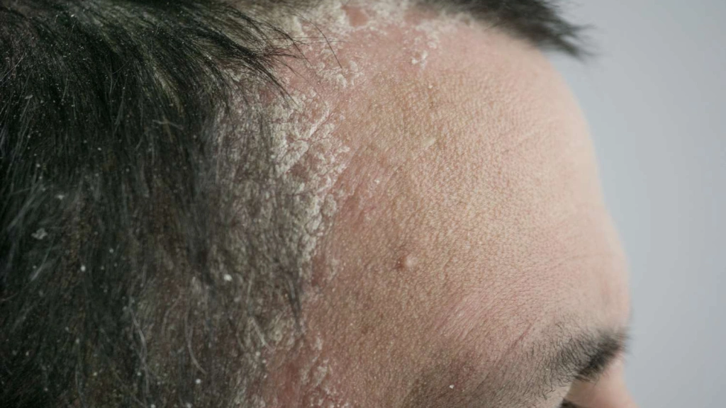 Scalp Psoriasis Image