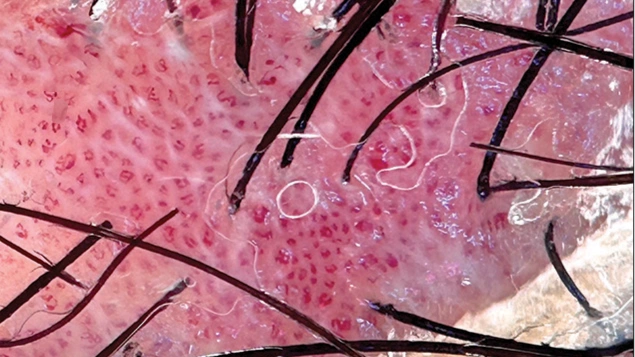 Scalp Psoriasis Dermoscopy