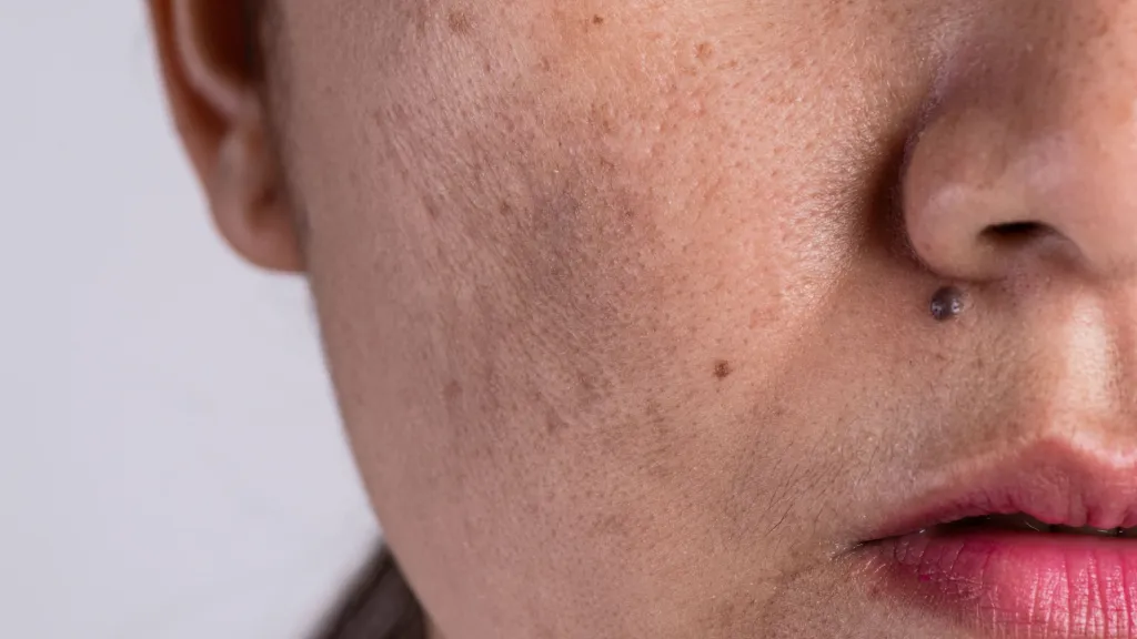 Overview of Melasma