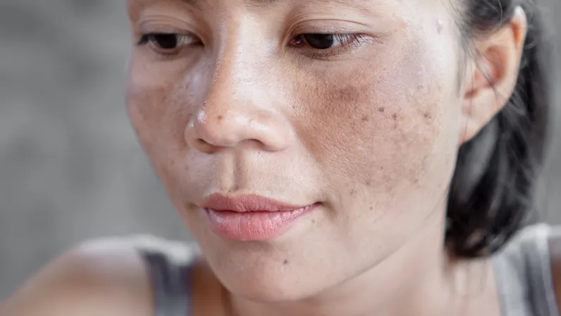 Melasma in the Face