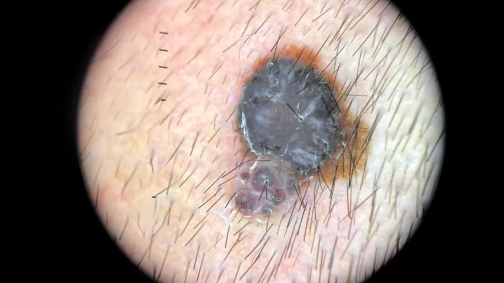 nodular melanoma skin cancer