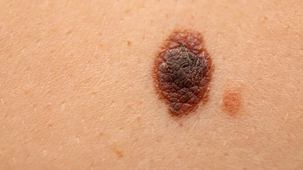 malignant melanoma