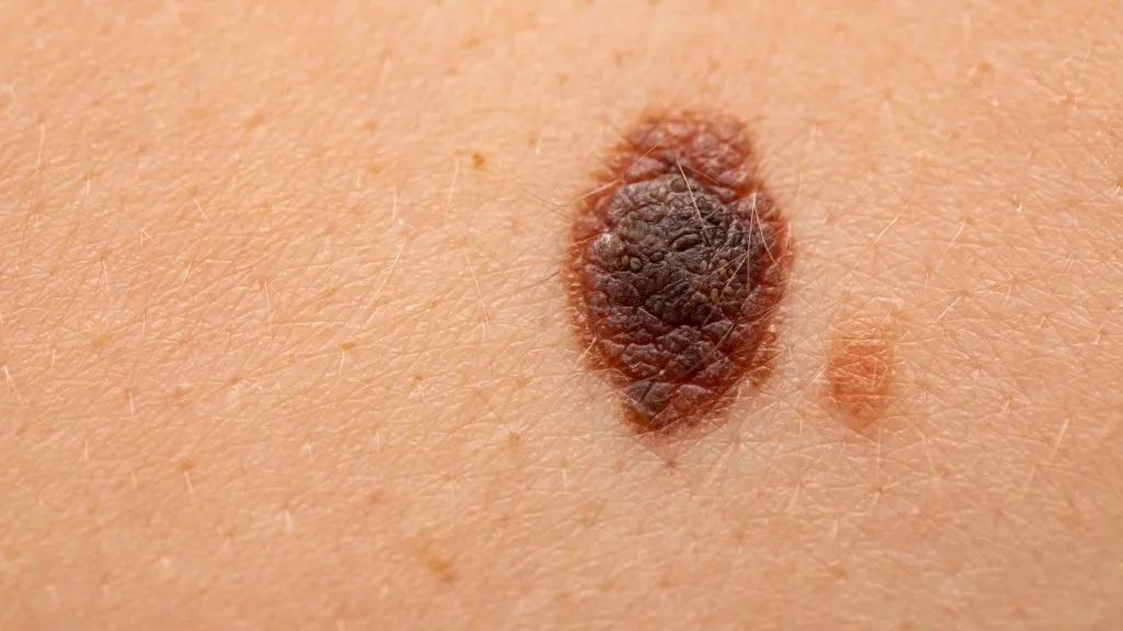 malignant melanoma