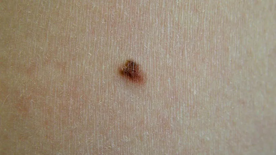 melanoma