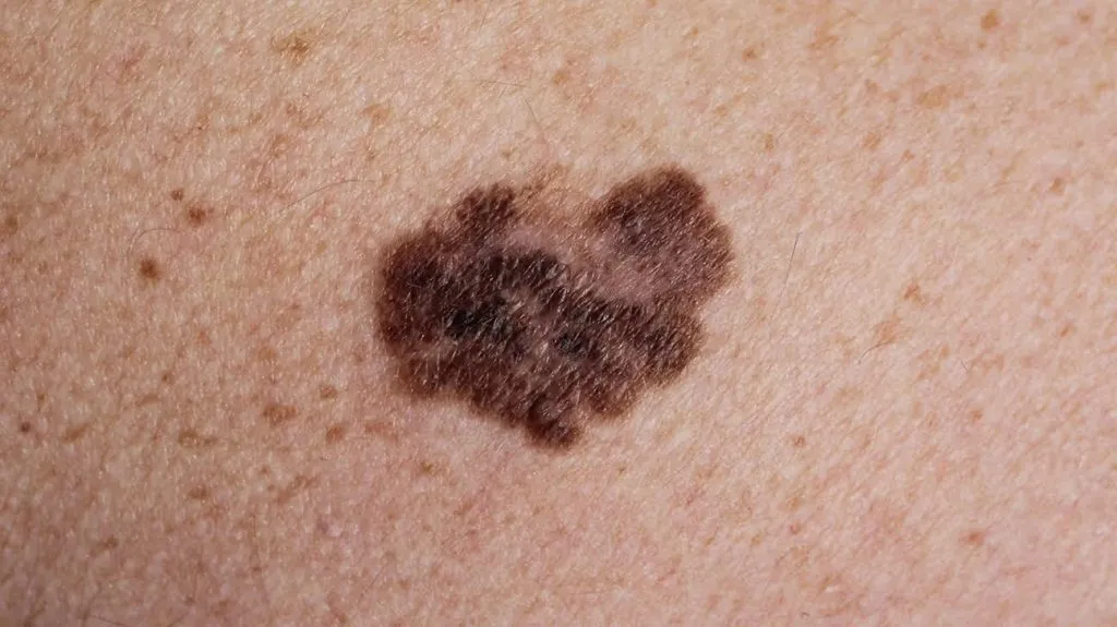 superficial-spreading melanoma