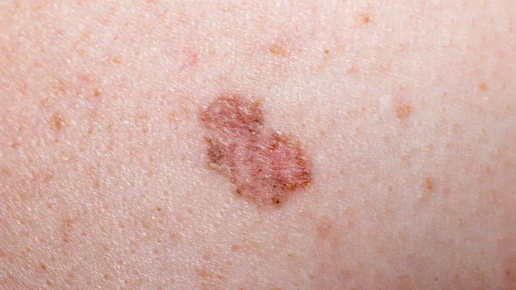 basal cell carcinoma