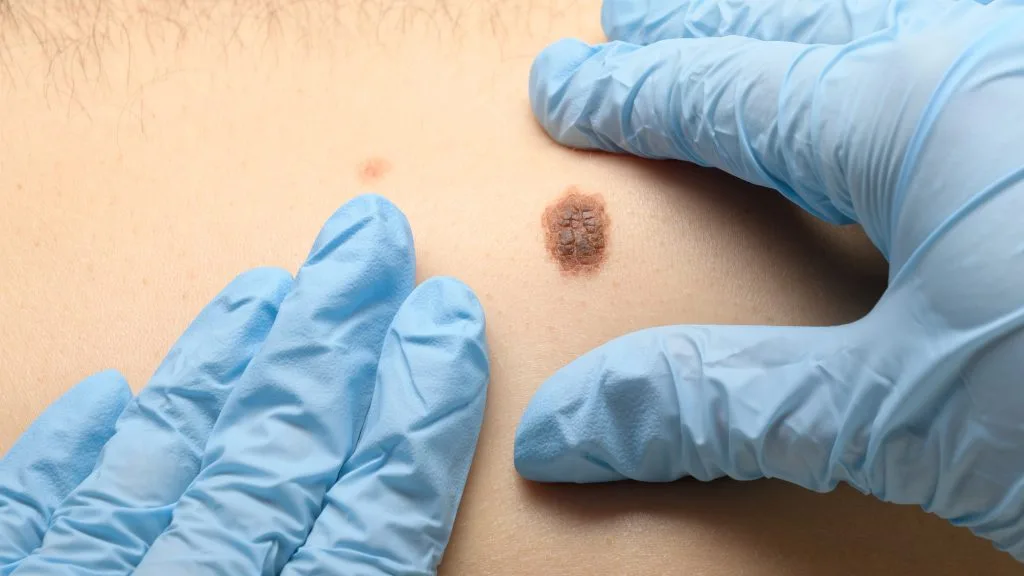 Naked-eyes examination of the mole 