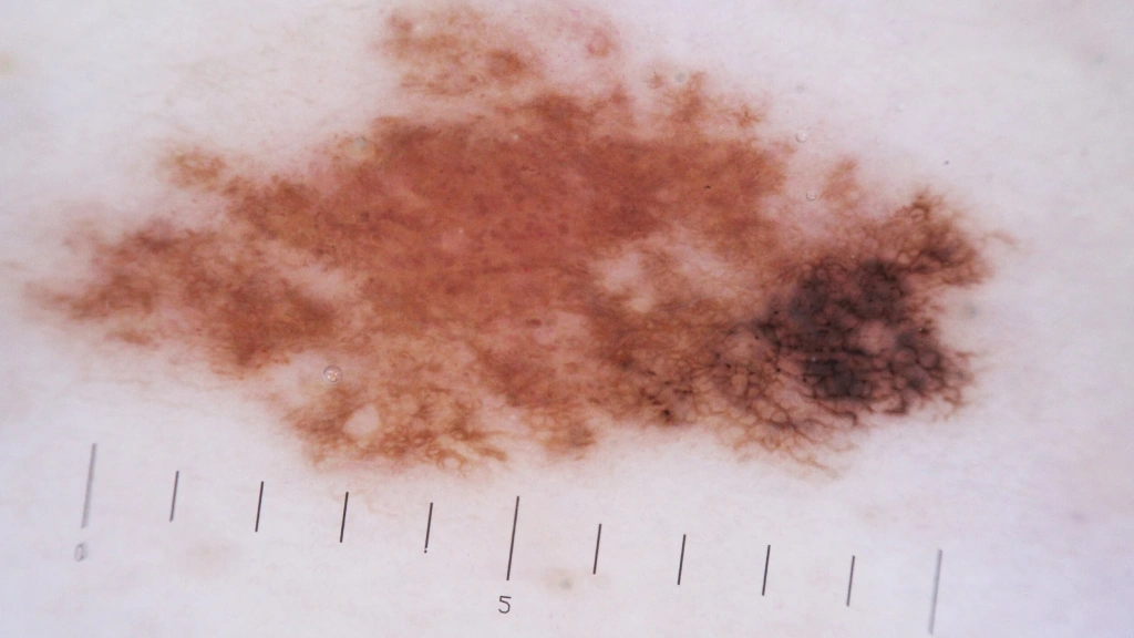Melanoma under Dermatoscope