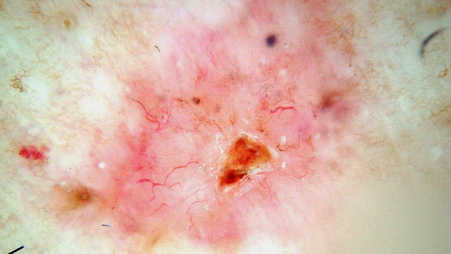 Basal cell carcinoma dermatoscope