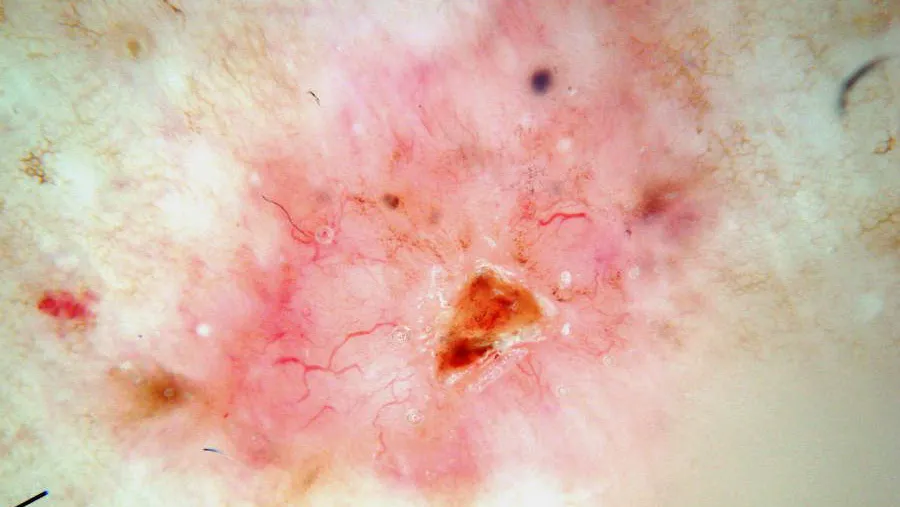 Basal cell carcinoma dermatoscope
