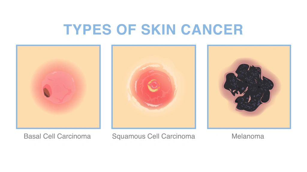 common skin cancers