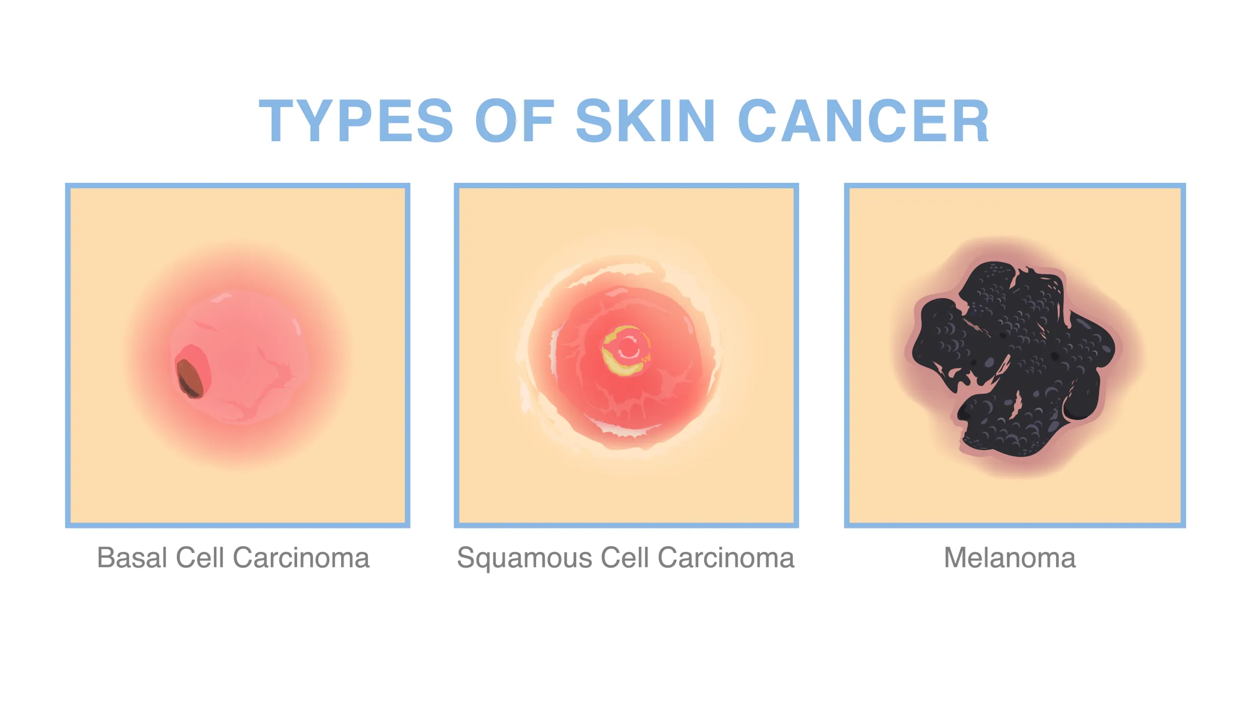 common skin cancers