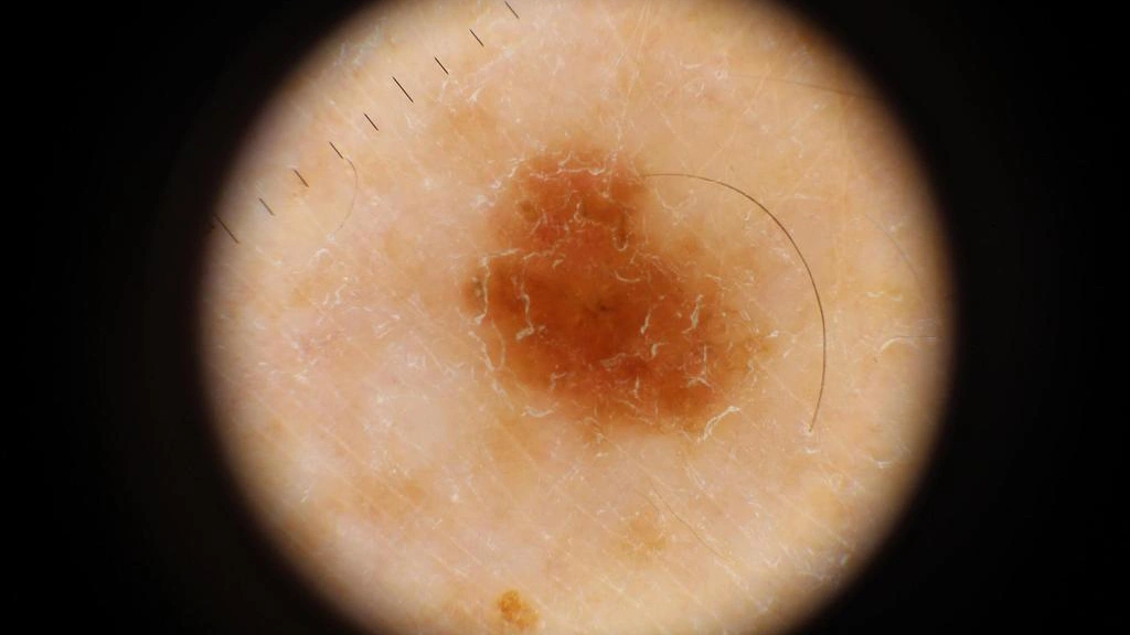 melanoma dermatoscope
