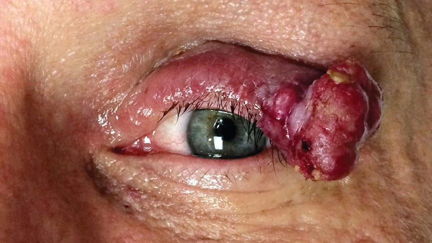 Merkel Cell Carcinoma