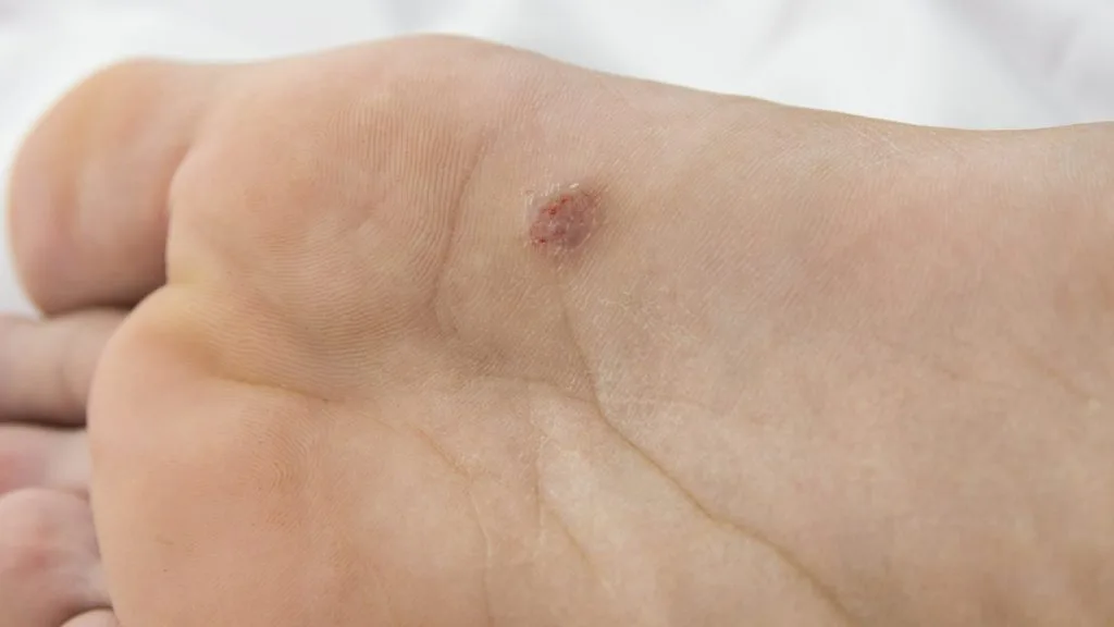 Acral Lentiginous Melanoma 3