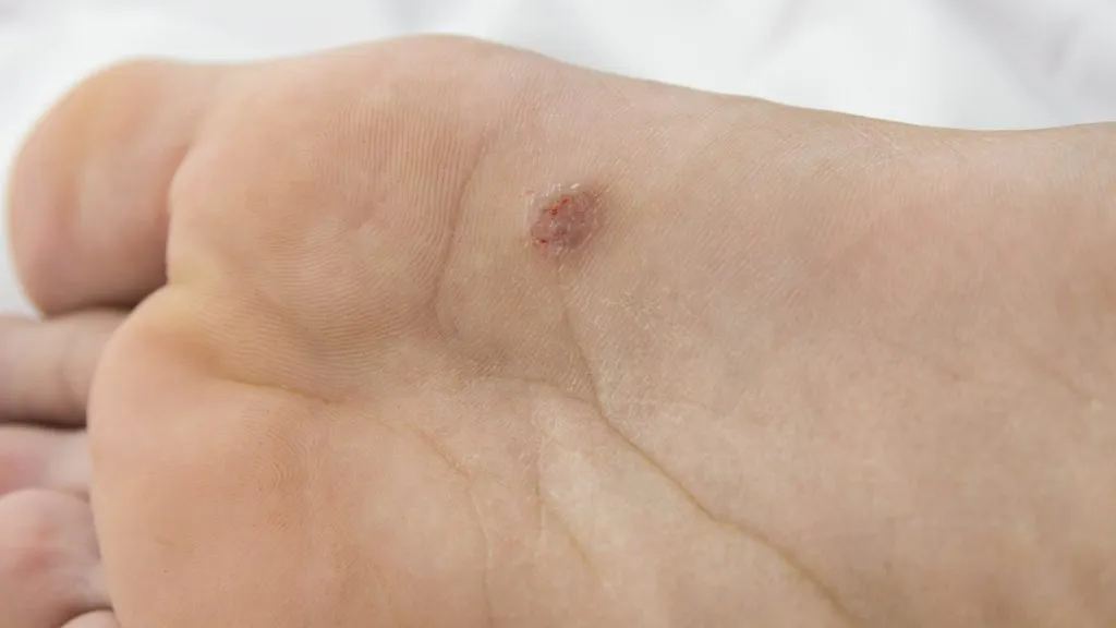 Acral Lentiginous Melanoma 3