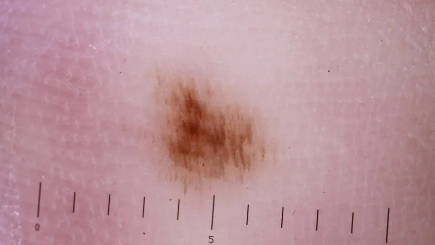 Acral Lentiginous Melanoma dermatoscope