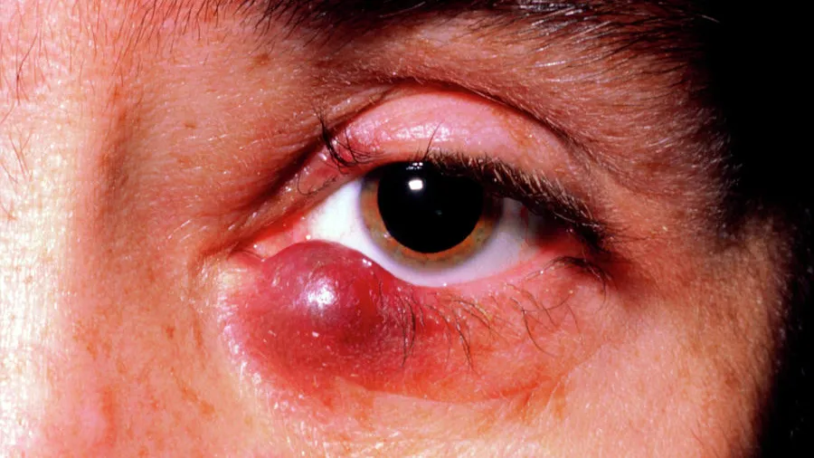 Kaposi's Sarcoma