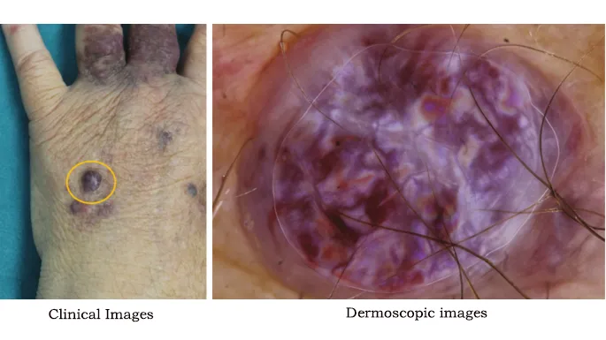 kaposi's sarcoma dermatoscope2