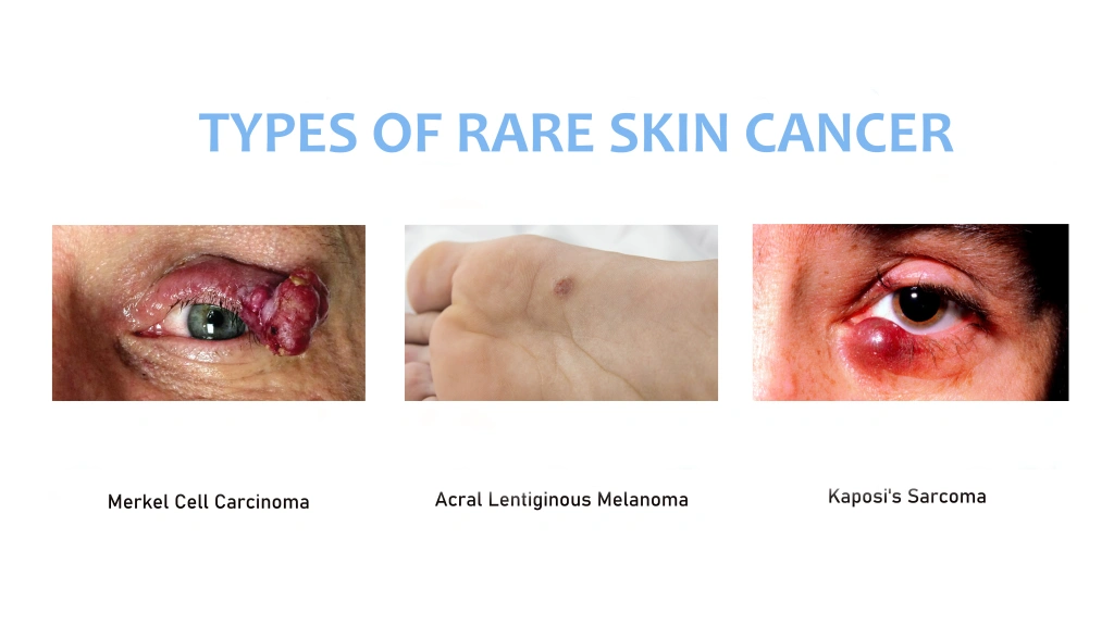 rare skin cancer