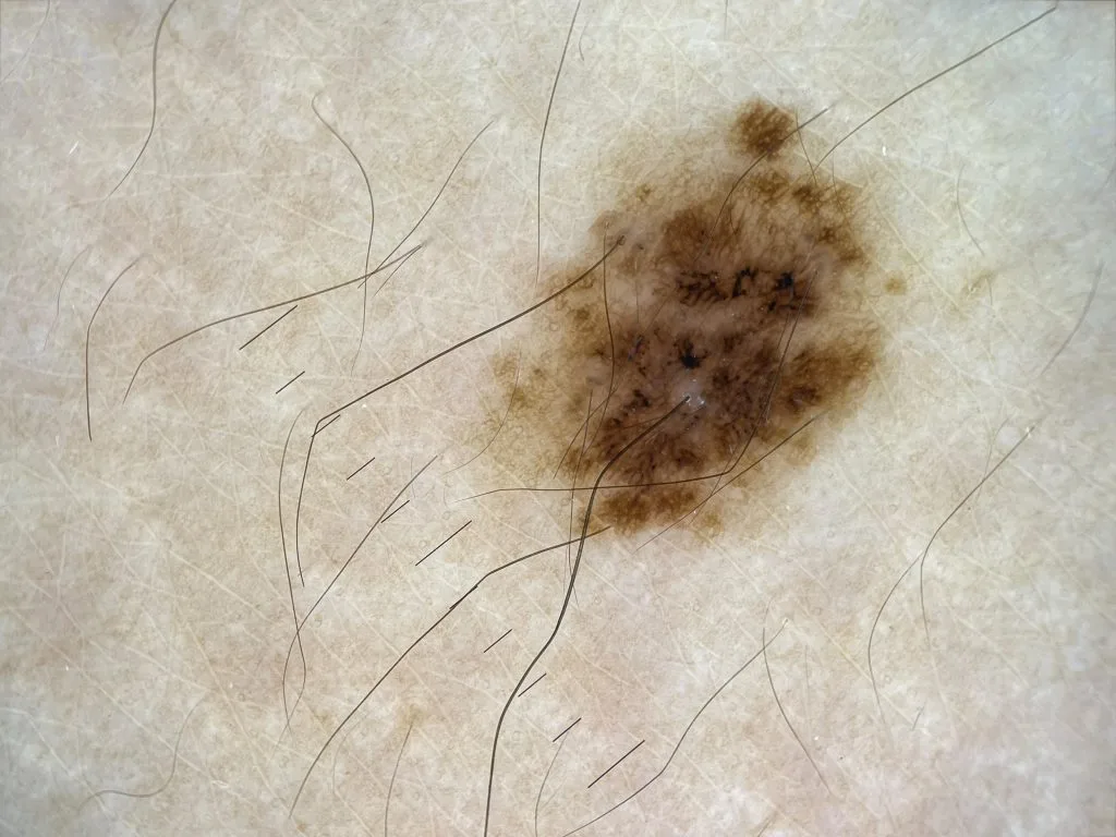 IBOOLO Smartphone Dermascopy